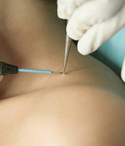 Mole Removal